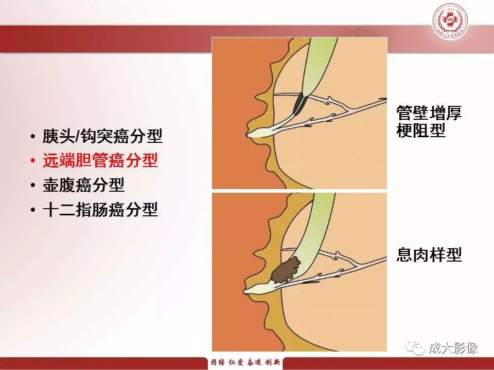 影像PPT - 【PPT】壶腹部周围癌的鉴别-14
