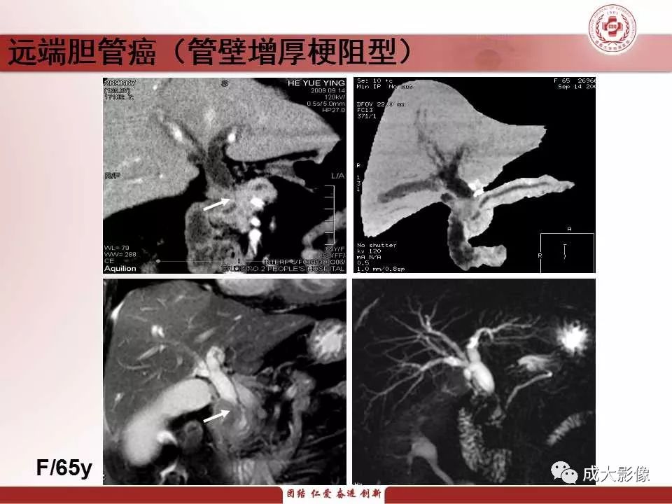 影像PPT - 【PPT】壶腹部周围癌的鉴别-15