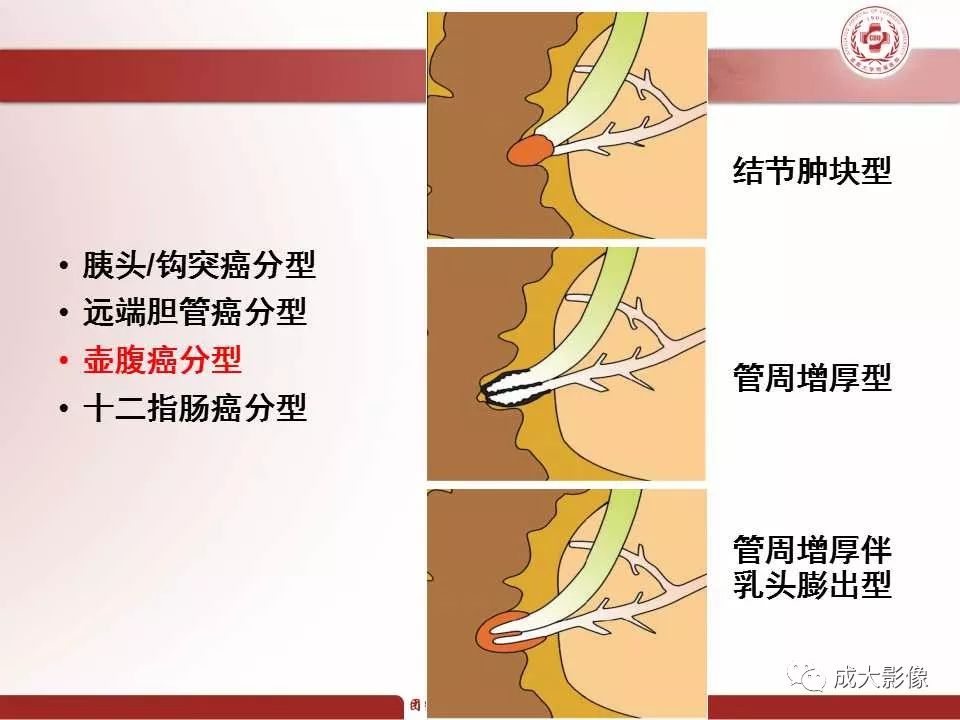 影像PPT - 【PPT】壶腹部周围癌的鉴别-18