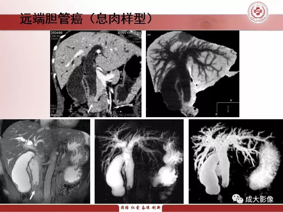 影像PPT - 【PPT】壶腹部周围癌的鉴别-17