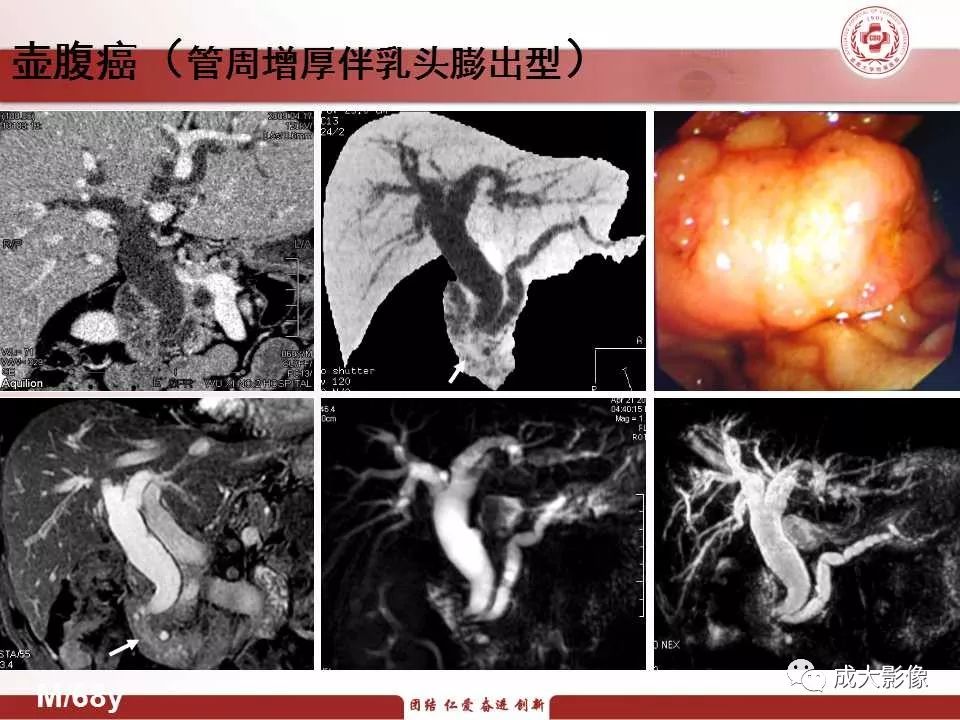 影像PPT - 【PPT】壶腹部周围癌的鉴别-21