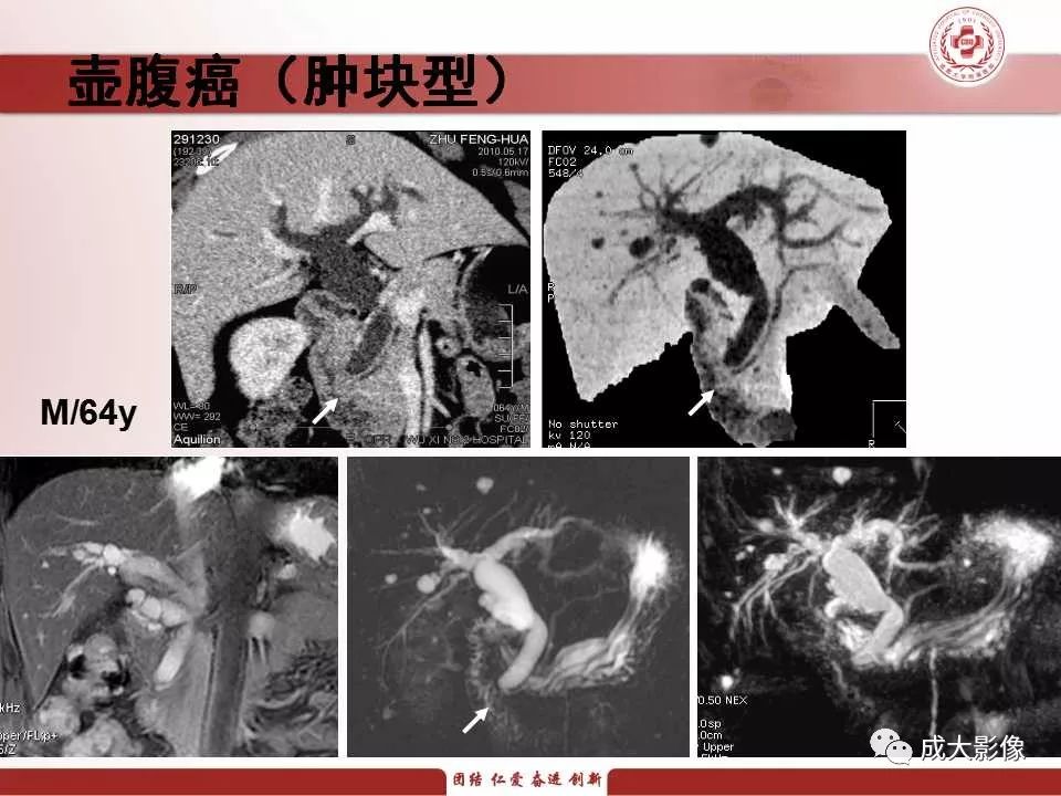 影像PPT - 【PPT】壶腹部周围癌的鉴别-20