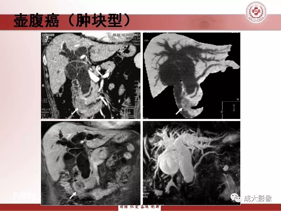 影像PPT - 【PPT】壶腹部周围癌的鉴别-19