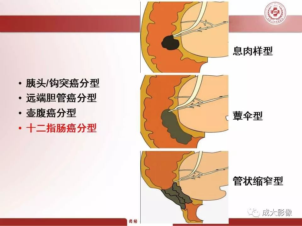 影像PPT - 【PPT】壶腹部周围癌的鉴别-22
