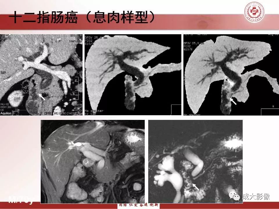 影像PPT - 【PPT】壶腹部周围癌的鉴别-23