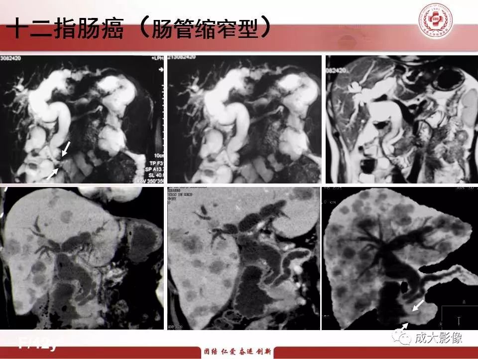 影像PPT - 【PPT】壶腹部周围癌的鉴别-24