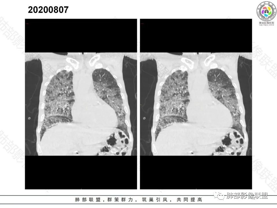 影像PPT - 【病例】钩端螺旋体病弥漫肺出血1例CT影像-12 影像PPT - 【病例】钩端螺旋体病弥漫肺出血1例CT影像-12