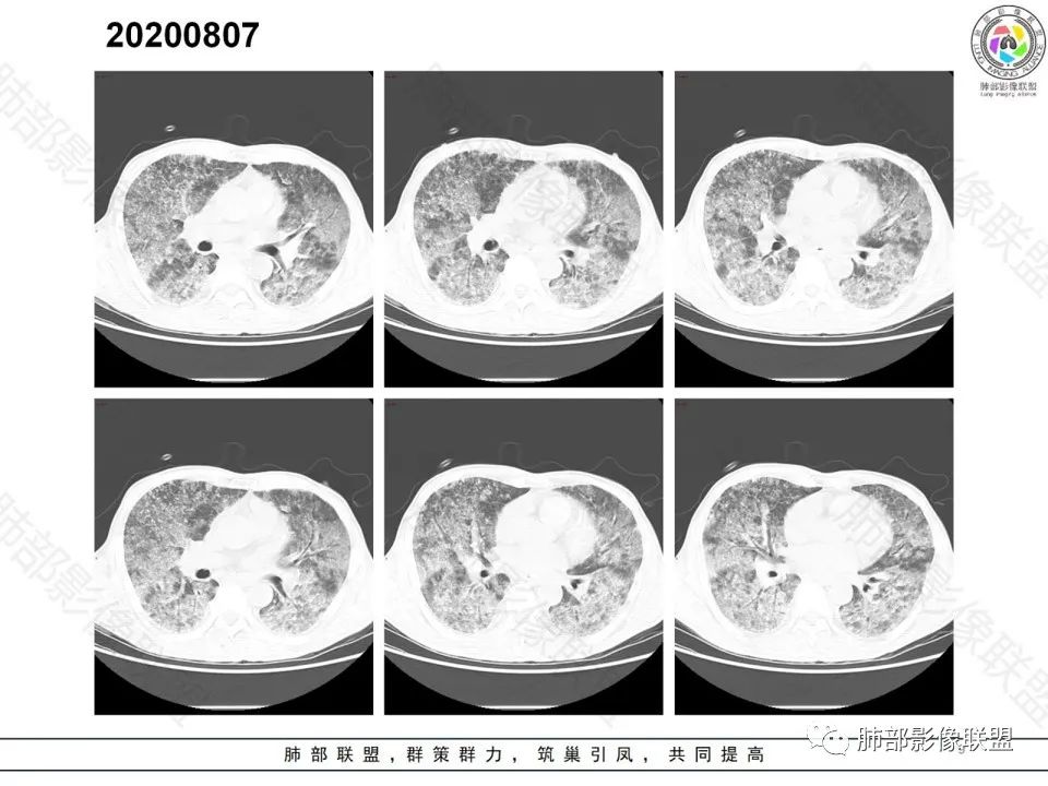 影像PPT - 【病例】钩端螺旋体病弥漫肺出血1例CT影像-9 影像PPT - 【病例】钩端螺旋体病弥漫肺出血1例CT影像-9