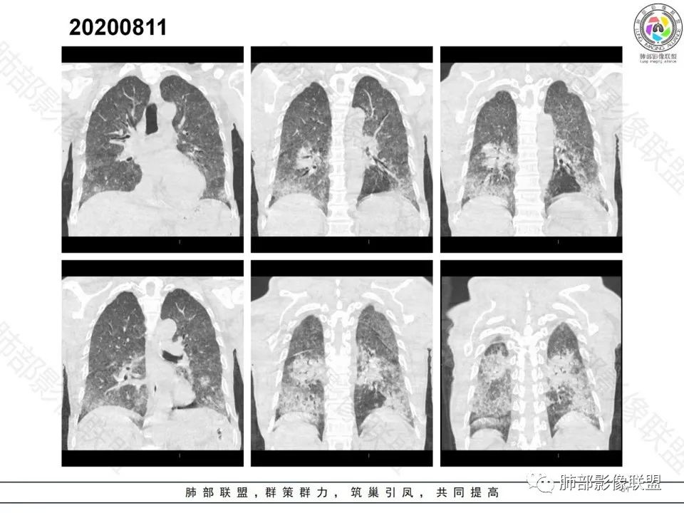 影像PPT - 【病例】钩端螺旋体病弥漫肺出血1例CT影像-13 影像PPT - 【病例】钩端螺旋体病弥漫肺出血1例CT影像-13