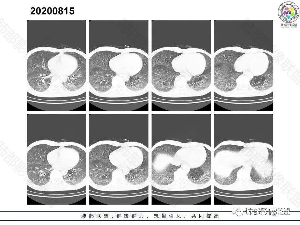 影像PPT - 【病例】钩端螺旋体病弥漫肺出血1例CT影像-15 影像PPT - 【病例】钩端螺旋体病弥漫肺出血1例CT影像-15