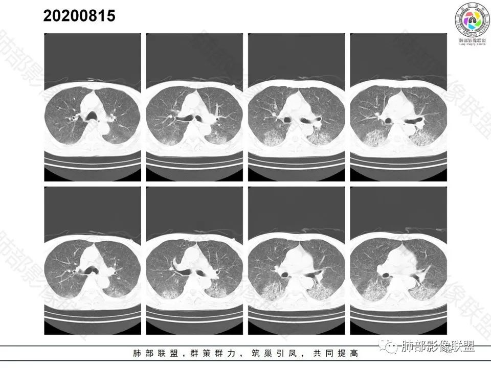 影像PPT - 【病例】钩端螺旋体病弥漫肺出血1例CT影像-14 影像PPT - 【病例】钩端螺旋体病弥漫肺出血1例CT影像-14