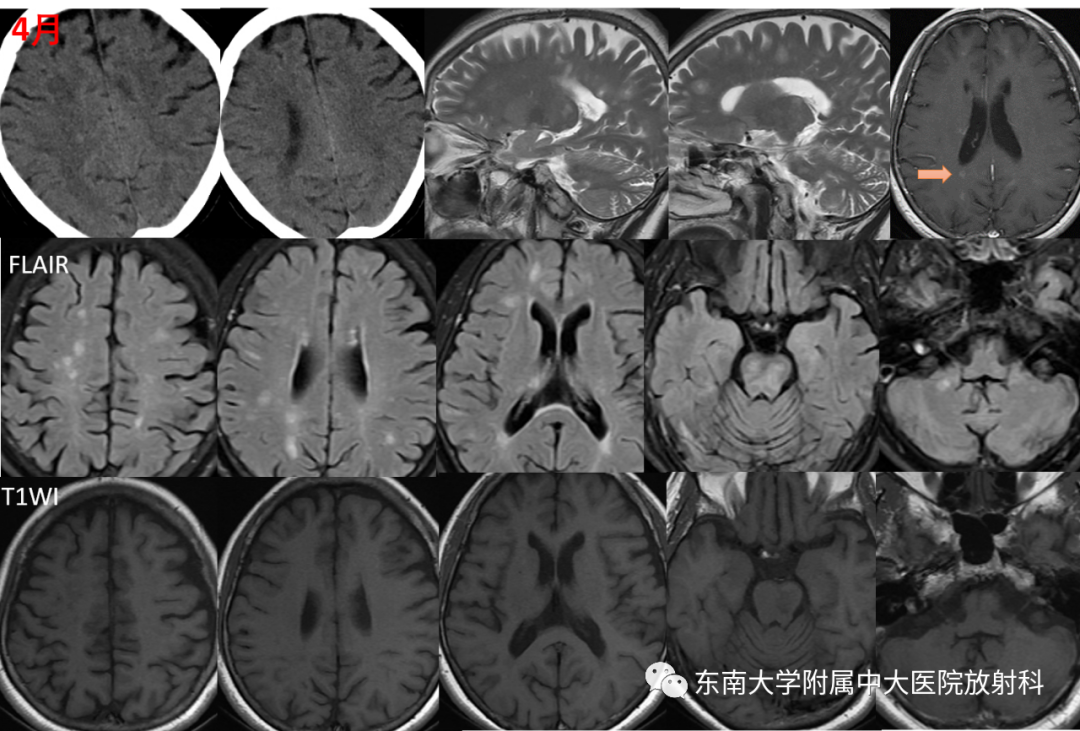 影像PPT - 【PPT】多发性硬化-1