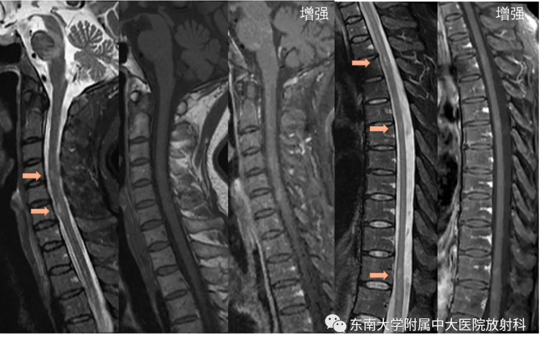 影像PPT - 【PPT】多发性硬化-2 影像PPT - 【PPT】多发性硬化-2