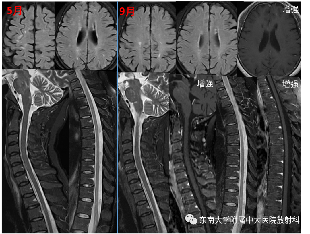 影像PPT - 【PPT】多发性硬化-3 影像PPT - 【PPT】多发性硬化-3