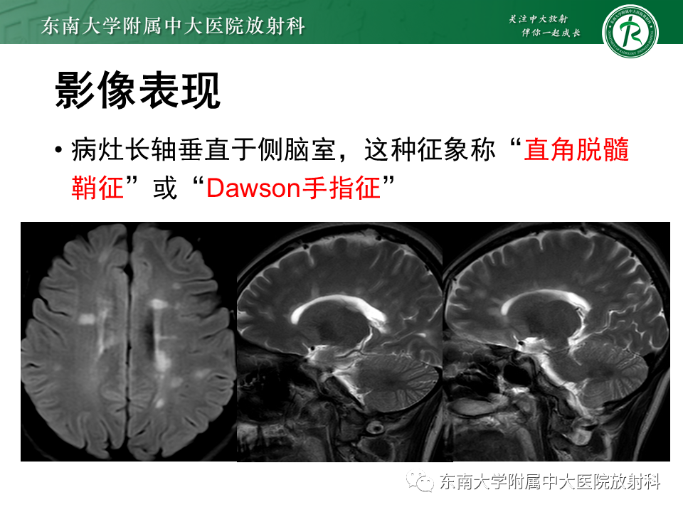 影像PPT - 【PPT】多发性硬化-14 影像PPT - 【PPT】多发性硬化-14