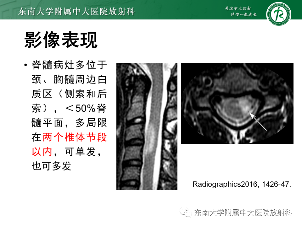 影像PPT - 【PPT】多发性硬化-16 影像PPT - 【PPT】多发性硬化-16