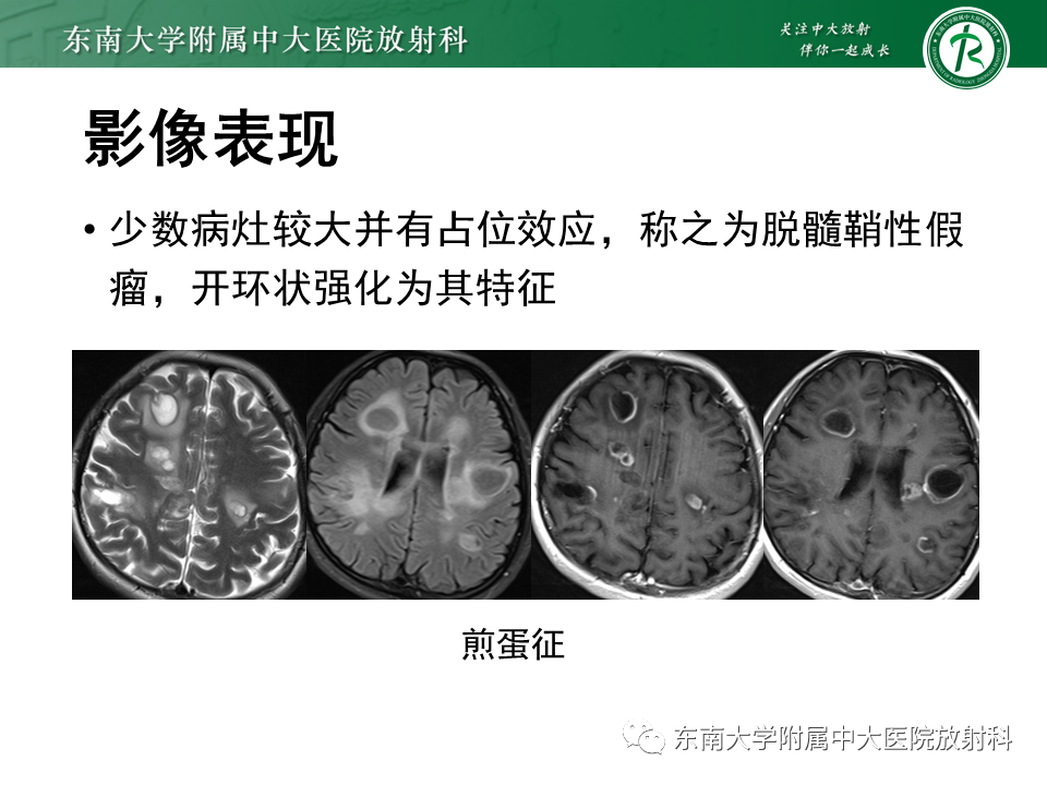 影像PPT - 【PPT】多发性硬化-15 影像PPT - 【PPT】多发性硬化-15