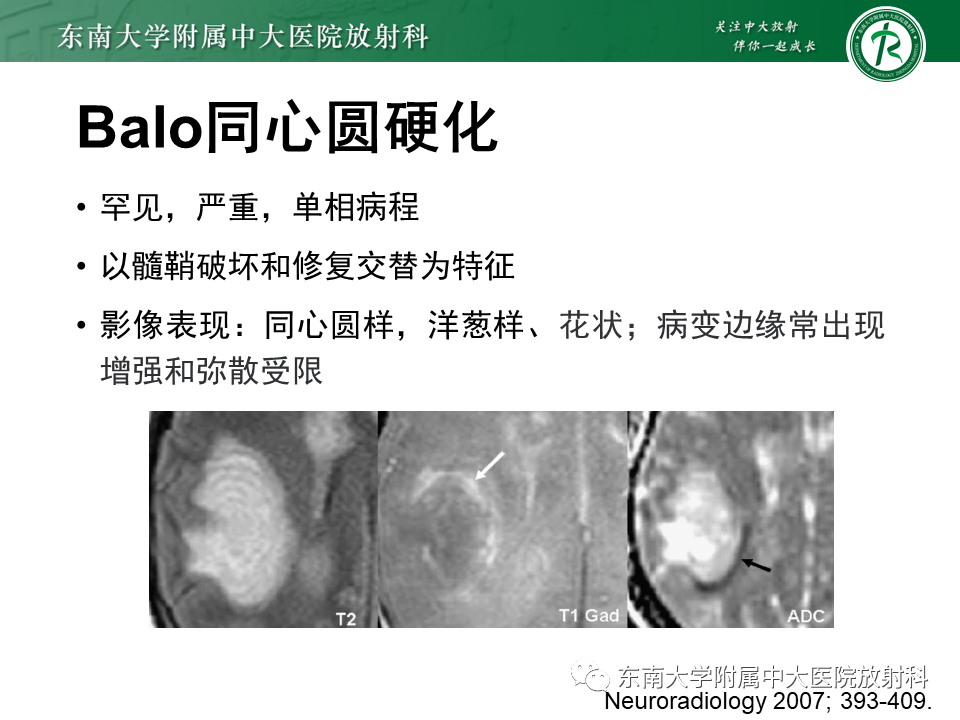 影像PPT - 【PPT】多发性硬化-20 影像PPT - 【PPT】多发性硬化-20