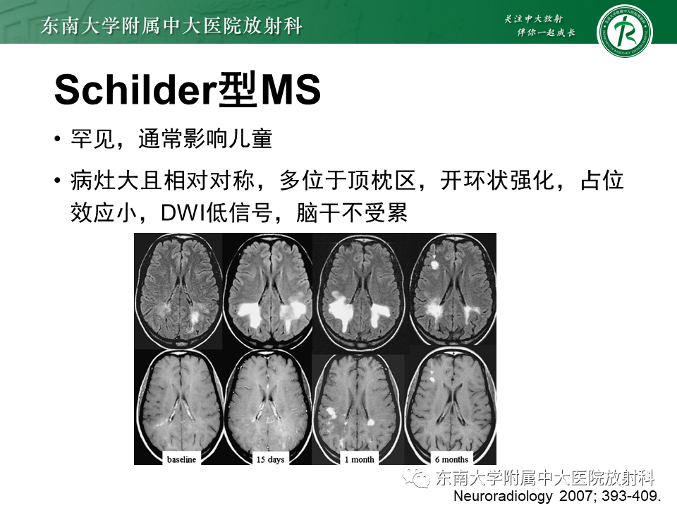 影像PPT - 【PPT】多发性硬化-19 影像PPT - 【PPT】多发性硬化-19