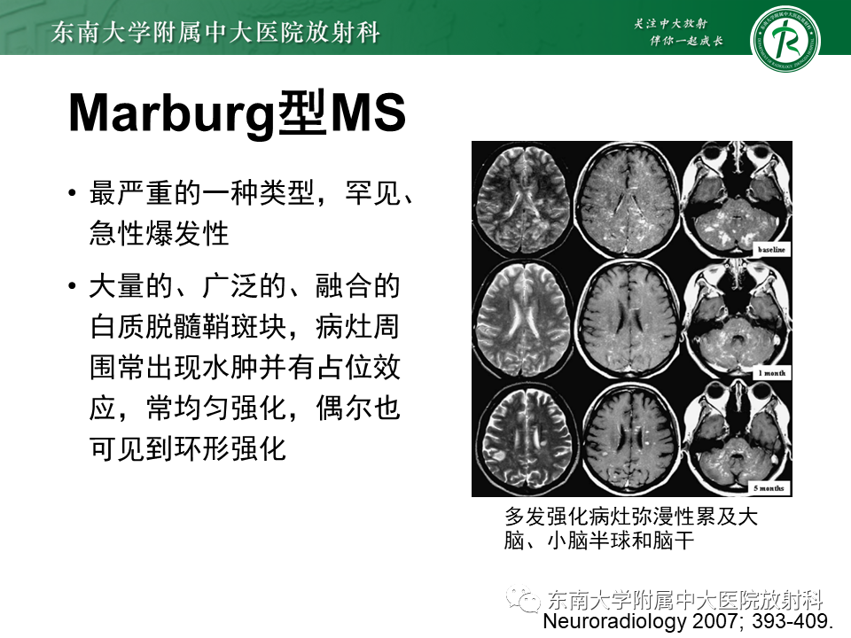 影像PPT - 【PPT】多发性硬化-18 影像PPT - 【PPT】多发性硬化-18