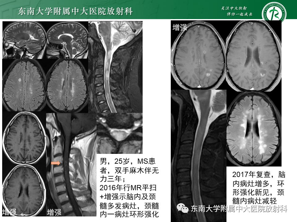影像PPT - 【PPT】多发性硬化-22 影像PPT - 【PPT】多发性硬化-22