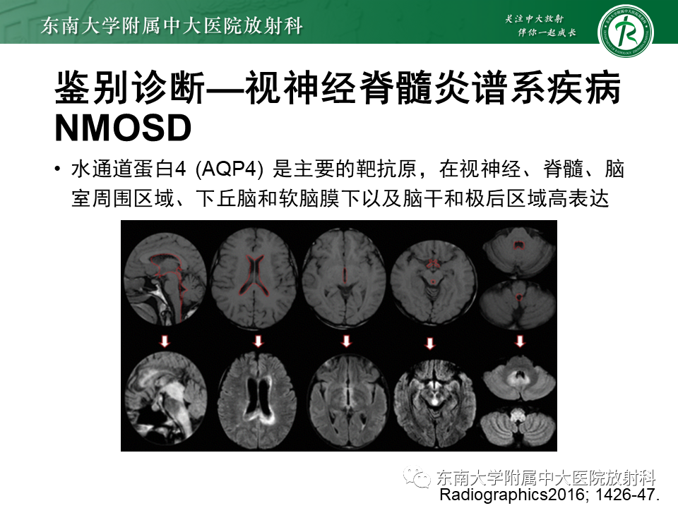影像PPT - 【PPT】多发性硬化-24 影像PPT - 【PPT】多发性硬化-24
