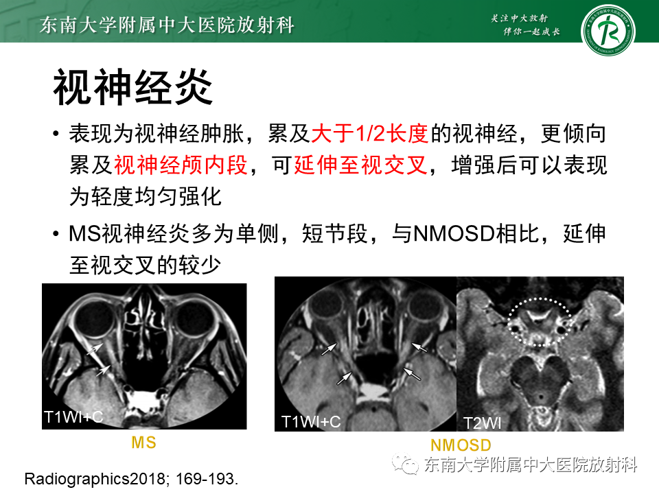 影像PPT - 【PPT】多发性硬化-25 影像PPT - 【PPT】多发性硬化-25