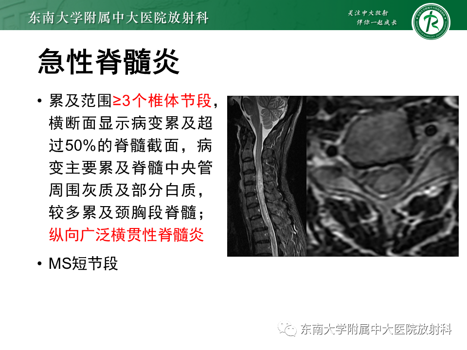 影像PPT - 【PPT】多发性硬化-26 影像PPT - 【PPT】多发性硬化-26