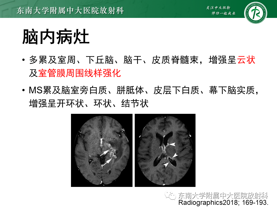 影像PPT - 【PPT】多发性硬化-27 影像PPT - 【PPT】多发性硬化-27