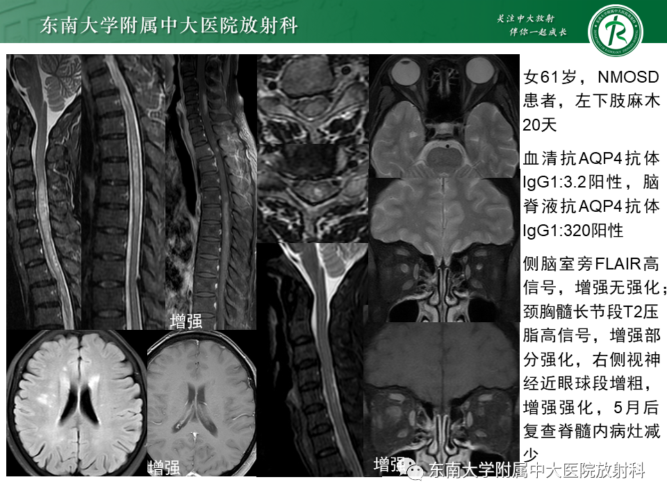 影像PPT - 【PPT】多发性硬化-28 影像PPT - 【PPT】多发性硬化-28