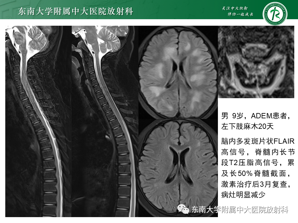 影像PPT - 【PPT】多发性硬化-32 影像PPT - 【PPT】多发性硬化-32