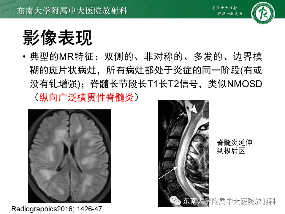 影像PPT - 【PPT】多发性硬化-31 影像PPT - 【PPT】多发性硬化-31