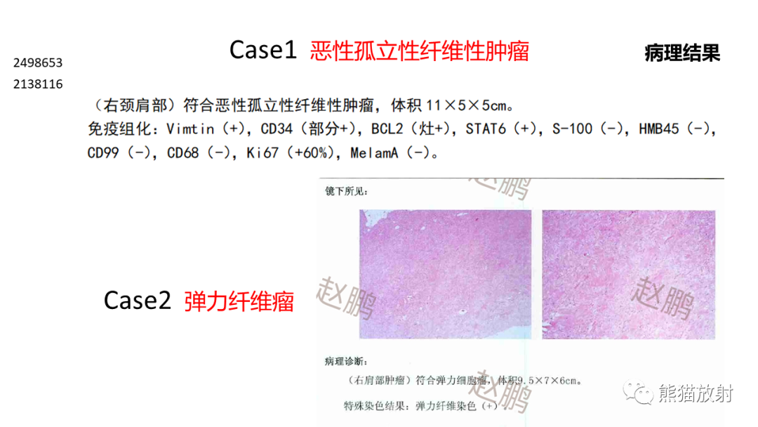 影像PPT - 【病例】胸壁恶性孤立性纤维性肿瘤 VS 弹力纤维瘤-18