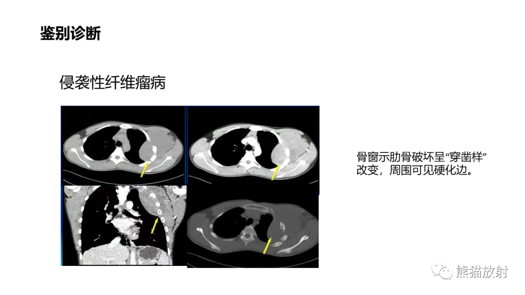 影像PPT - 【病例】胸壁恶性孤立性纤维性肿瘤 VS 弹力纤维瘤-22