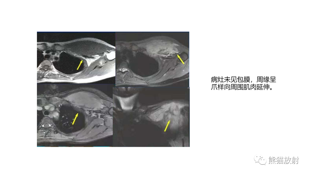 影像PPT - 【病例】胸壁恶性孤立性纤维性肿瘤 VS 弹力纤维瘤-23