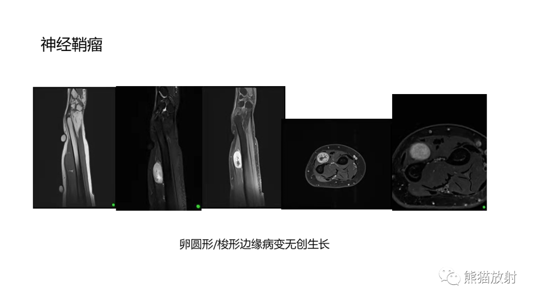影像PPT - 【病例】胸壁恶性孤立性纤维性肿瘤 VS 弹力纤维瘤-25