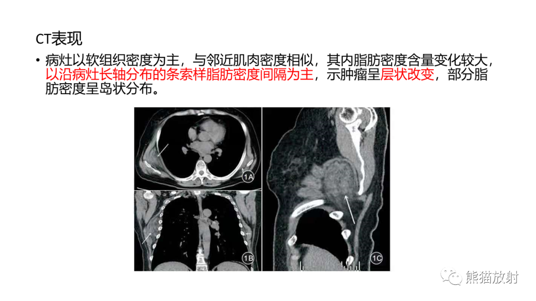 影像PPT - 【病例】胸壁恶性孤立性纤维性肿瘤 VS 弹力纤维瘤-27