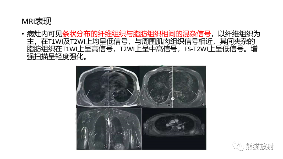 影像PPT - 【病例】胸壁恶性孤立性纤维性肿瘤 VS 弹力纤维瘤-28