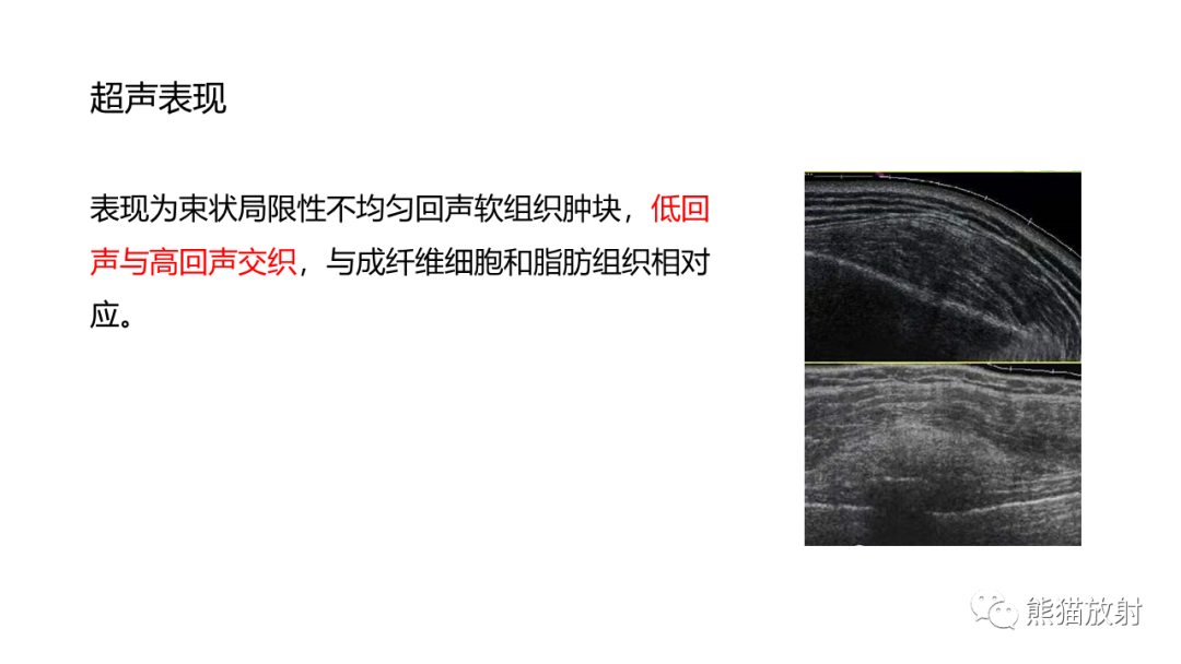 影像PPT - 【病例】胸壁恶性孤立性纤维性肿瘤 VS 弹力纤维瘤-29