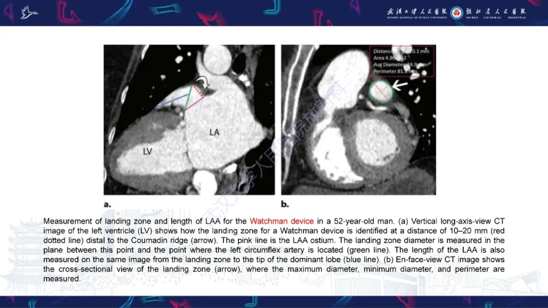 影像PPT - 【PPT】经导管左心耳封堵术CT评估-24