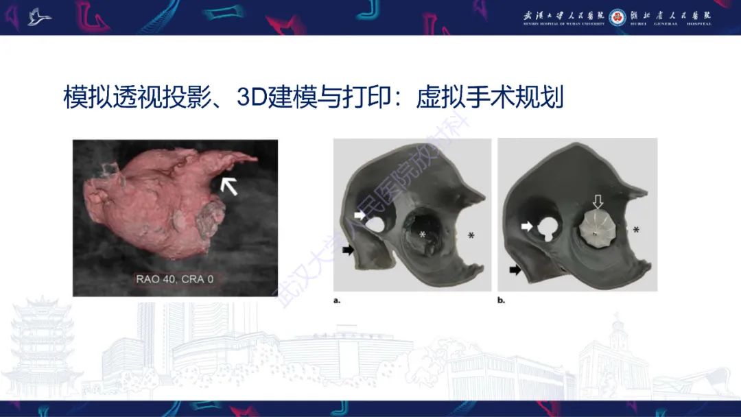 影像PPT - 【PPT】经导管左心耳封堵术CT评估-47