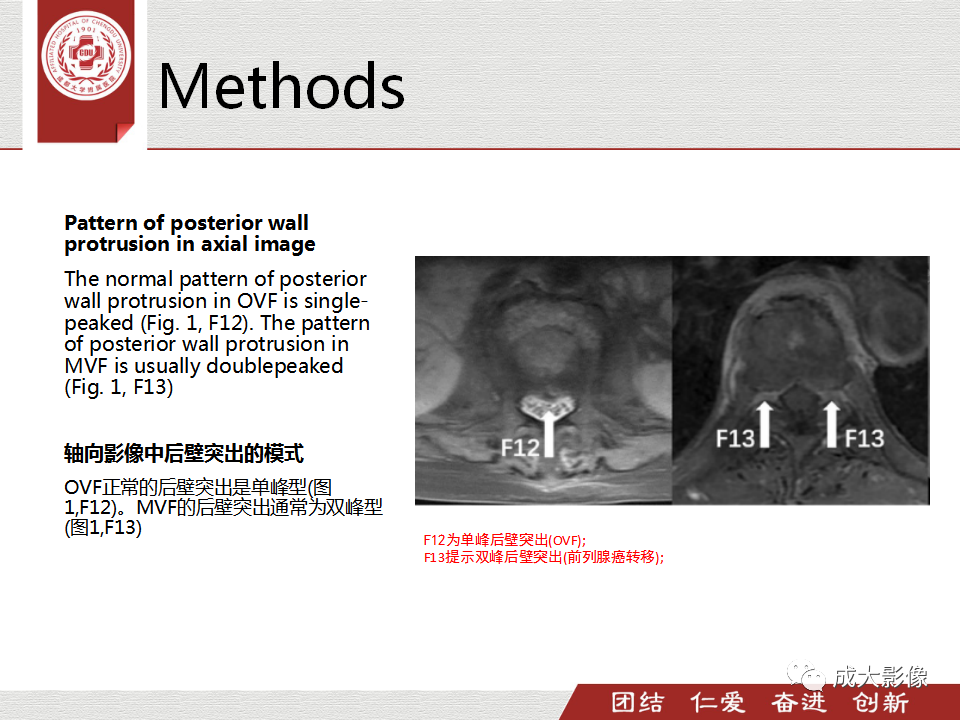 影像PPT - 【PPT】一种基于MRI和CT的新型评分系统用于区分中国患者骨质疏松性椎体骨折和恶性椎体骨折-14