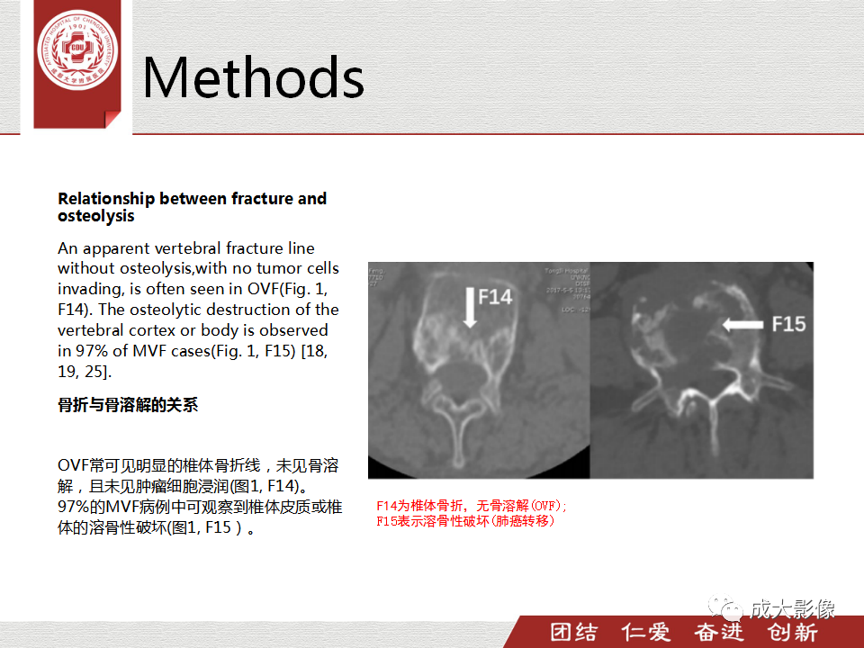 影像PPT - 【PPT】一种基于MRI和CT的新型评分系统用于区分中国患者骨质疏松性椎体骨折和恶性椎体骨折-16