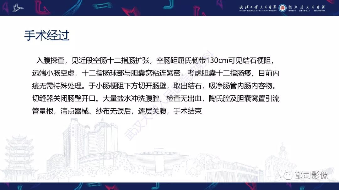 影像PPT - 【PPT】胆结石性肠梗阻影像诊断-4