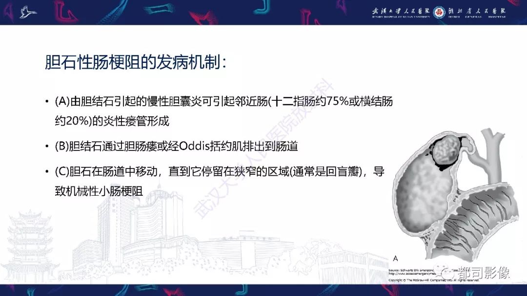 影像PPT - 【PPT】胆结石性肠梗阻影像诊断-9