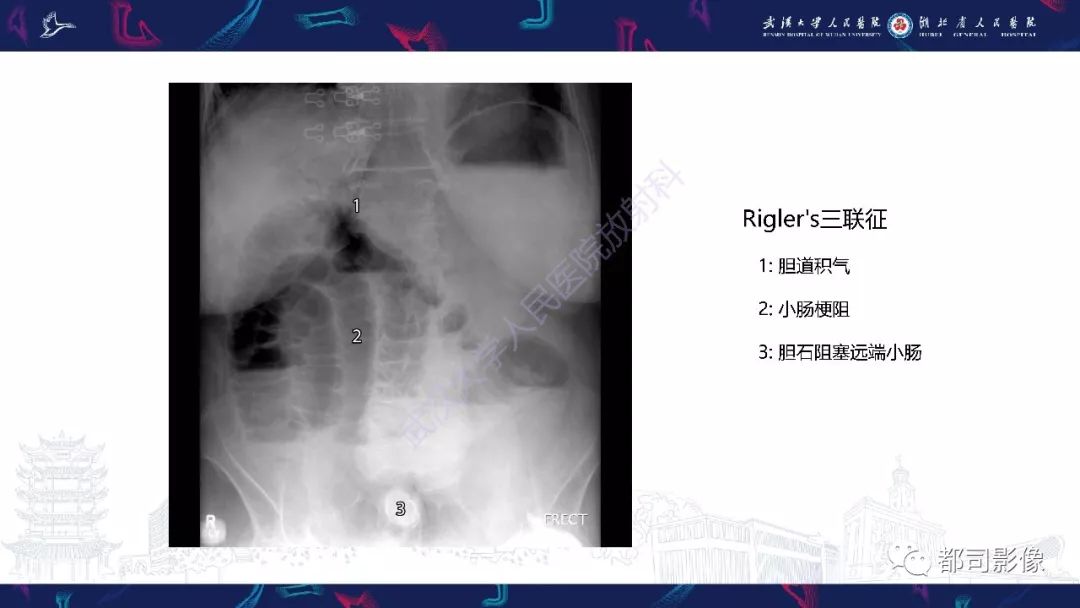 影像PPT - 【PPT】胆结石性肠梗阻影像诊断-12