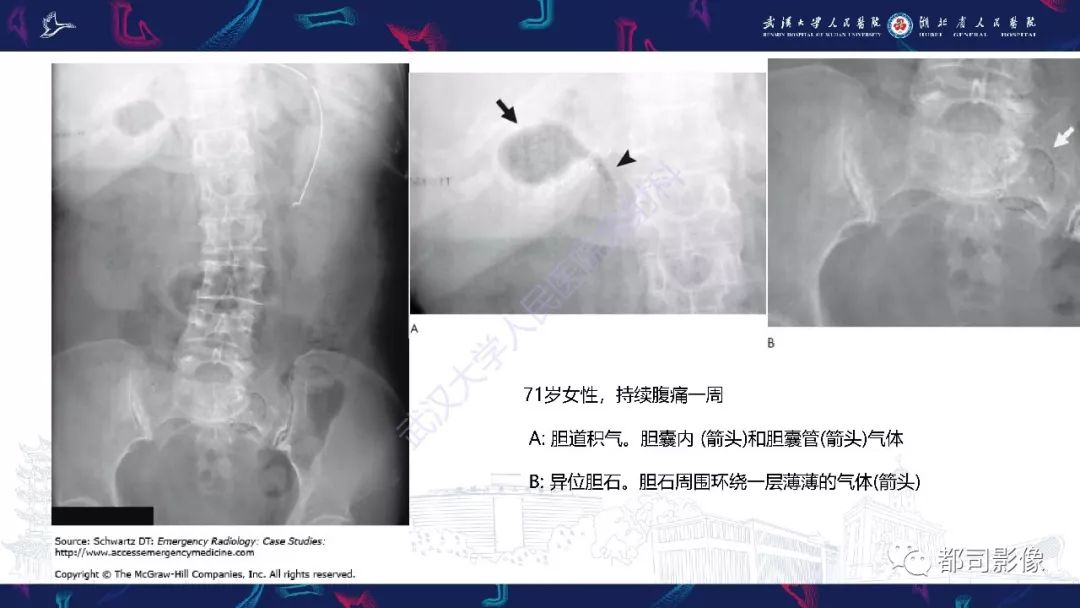 影像PPT - 【PPT】胆结石性肠梗阻影像诊断-13