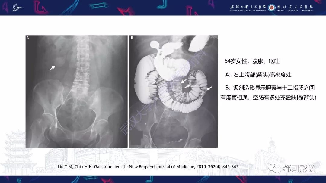影像PPT - 【PPT】胆结石性肠梗阻影像诊断-14