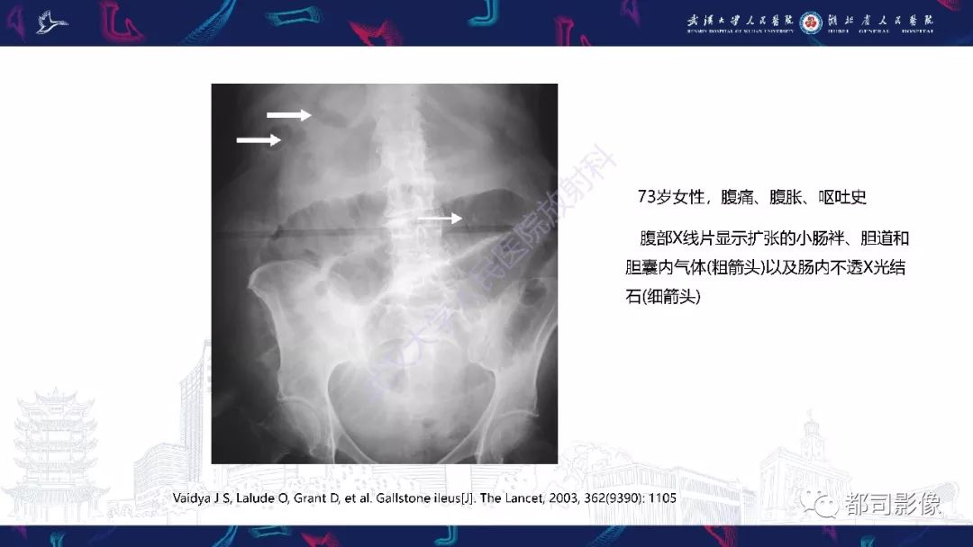 影像PPT - 【PPT】胆结石性肠梗阻影像诊断-15