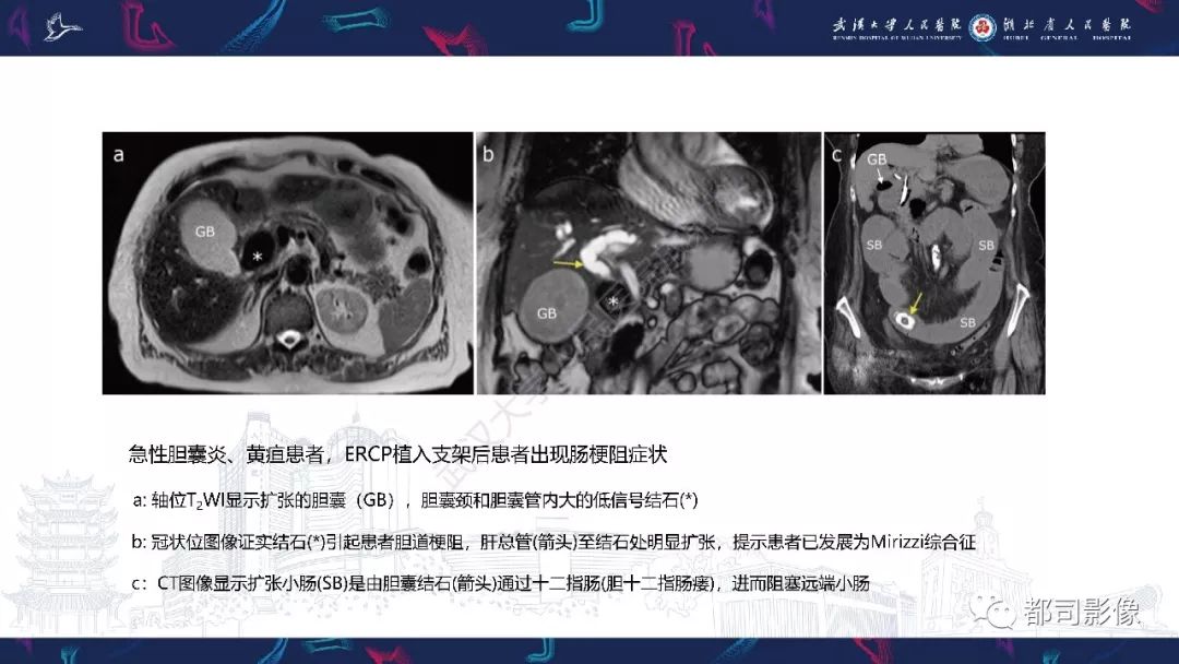 影像PPT - 【PPT】胆结石性肠梗阻影像诊断-18